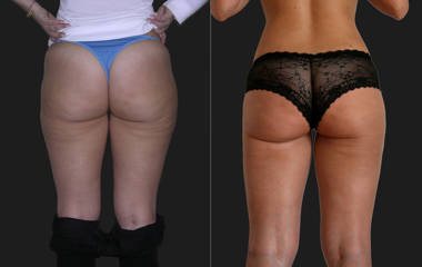 Before and after liposuction and body contouring showing lifted buttocks and smoother thighs