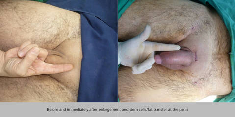 Before and after penile enlargement with stem cell and fat transfer procedure