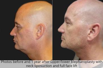 Before and one year after upper and lower blepharoplasty with neck liposuction and full face lift side view