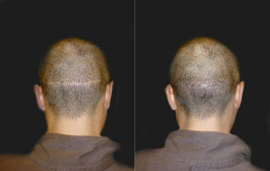 Before and after hair transplantation showing restored hair density and natural looking scalp coverage
