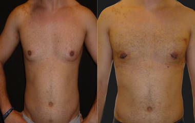 Before and after gynecomastia surgery showing flatter, masculine chest contour and natural symmetry