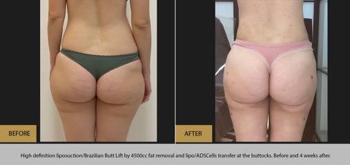 Before and after results of high-definition liposuction and Brazilian Butt lift showing improved contour