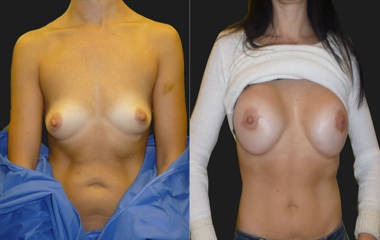 Before and after breast augmentation showing natural looking results and improved fuller with silicone implants