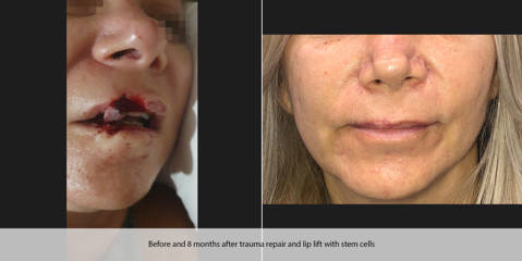 Before and after comparison of facial trauma repair and lip reconstruction using stem cells