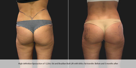 Before and three months after high-definition liposuction and Brazilian Butt Lift showing sculpted waist and lifted buttocks