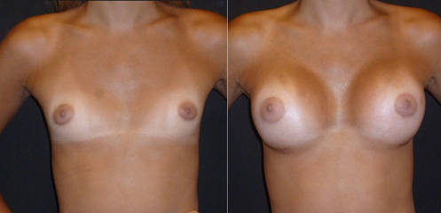 Before and after breast augmentation showing enhanced volume and improved breast contour