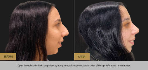 Side view before and after open rhinoplasty on thick skin patient with dorsal hump removal and tip refinement