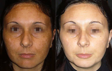 Before and after  comparison of a woman with reduced hyperpigmentation and more even skin tone