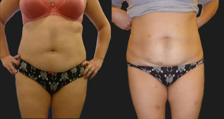 Before and after mesotherapy lipolysis on the abdomen showing smoother surface and reduction of fat deposits