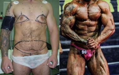 Before and after male body contouring surgery showing refined torso and improved waistline