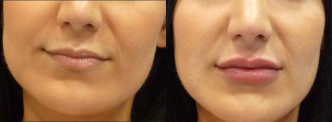 Before and after lip filler treatment showing fuller, balanced lips with natural contour
