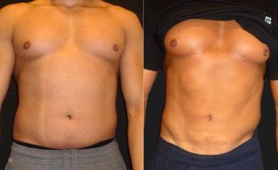 Before and after male high-definition liposuction showing sculpted abs and enhanced muscle definition