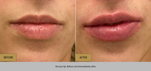 Before and after Russian lip treatment