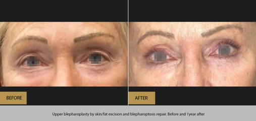Before and after upper blepharoplasty with skin and fat excision and blepharoptosis repair