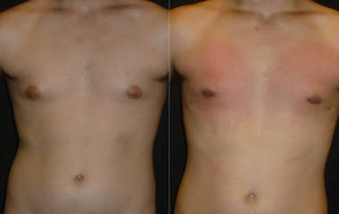 Before and after gynecomastia removal with improved chest symmetry and natural contour