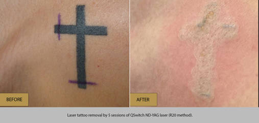 Before and after laser tattoo removal by 5 sessions of QSwitch