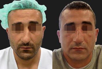 Before and after rhinoplasty showing correction of nasal asymmetry and improved nasal contour