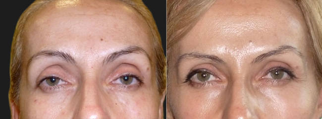 Before and after upper-face botulinum toxin treatment showing reduced forehead lines and smoother skin