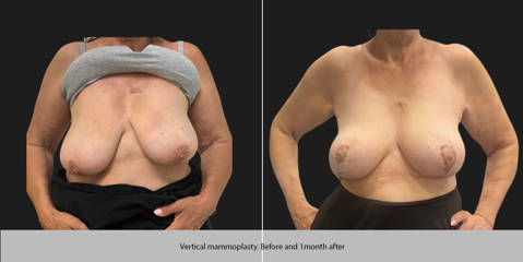 Before and after vertical mammoplasty showing lifted and firmer breast contour one month post surgery
