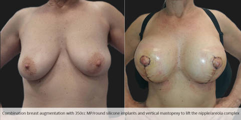 Before and after combined breast lift and augmentation with 350cc round silicone implants showing lifted, fuller contour