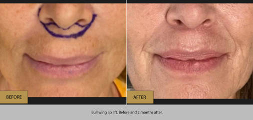 Before and after lip filler treatment showing fuller lips with refined upper-lip contour