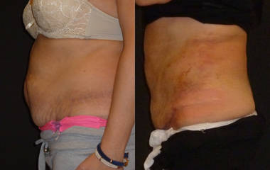 Comparison showing abdomen before and after liposuction, with visible reduction of fat and smoother skin appearance