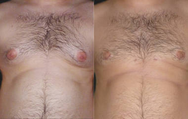 Before and after gynecomastia surgery showing reduced gland tissue and improved flat chest contour