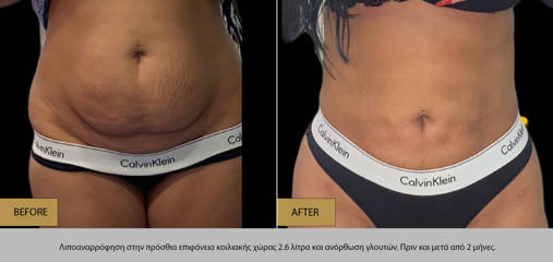 Before and after female abdominal liposuction showing improved body contour and reduced flank fat