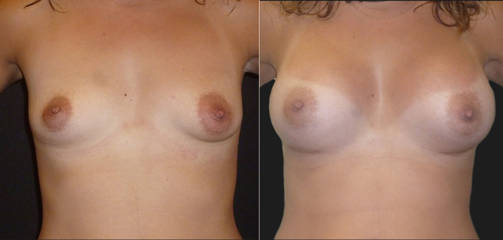 Before and after breast augmentation showing enhanced volume and improved breast contour