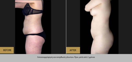Before and two years after liposuction and buttock lift showing flatter abdomen and improved body contour