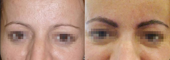 Before and after eyebrow micropigmentation showing pigment application for fuller, precisely shaped brows