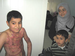 Young burn patient receiving post-treatment care during humanitarian medical outreach