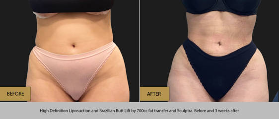 Before and after high-definition liposuction and Brazilian Butt Lift showing slimmer waist and enhanced curves