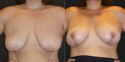 Before and after breast reduction showing lifted and firmer breast shape