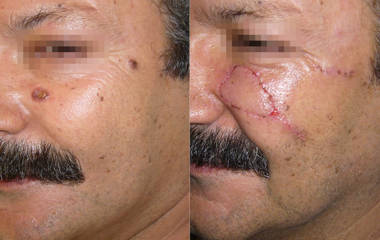 Before and after skin cancer removal and facial reconstruction on the right cheek, showing healing progress