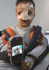 Young reconstructive patient showing recovery progress