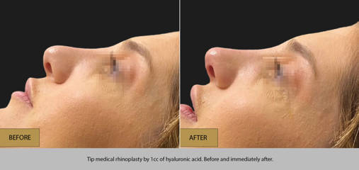 Before and after tip refinement using 1cc of hyaluronic acid in medical rhinoplasty