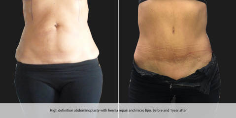 High definition abdominoplasty with hernia repair and micro liposuction and one year after