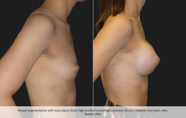 Breast augmentation with dual plane 350cc high profile silicone implants and stem cells, 3 weeks after