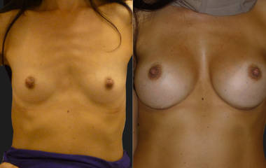 Before and after breast augmentation with silicone implants showing lifted appearance and enhanced volume