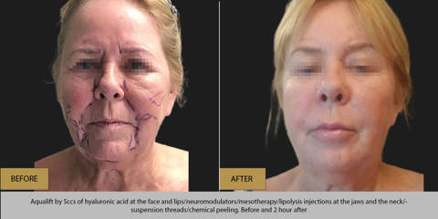 Before and 2 hours after aqualift by 5ccs of hyaluronic acid at the face and lips