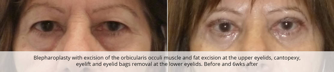 Before and after blepharoplasty with upper and lower eyelid fat removal showing smoother eye contour
