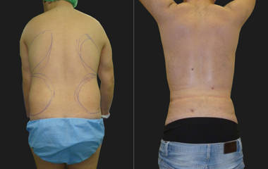 Before and after male back liposuction showing reduction of fat and improved contour