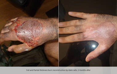 Before and 2 months after full and partial thickness burn reconstruction by stem cells
