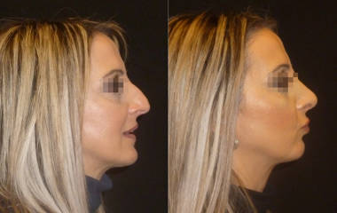 Side view before and after female rhinoplasty showing nasal hump correction and improved nasal tip definition