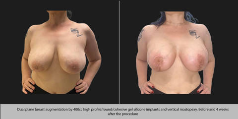 Before and after dual breast augmentation with 400cc high profile silicone implants and vertical lift