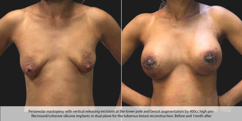 Before and after breast lift and augmentation with 400cc high profile implants correcting tuberous breasts