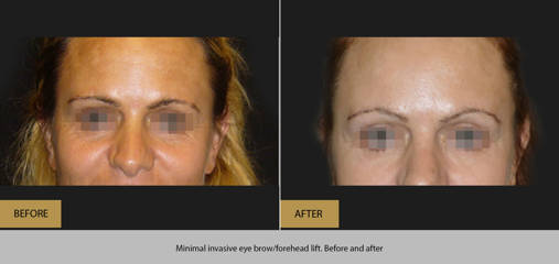 Before and after minimal invasive eyebrow lift