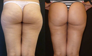 Before and after buttock and thigh liposuction showing smoother texture and enhanced body contour