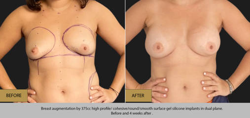 Breast augmentation by 375cc gel silicone implants in dual plane, before and 4 weeks after 
